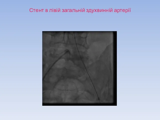 Стент в лівій загальній здухвинній артерії