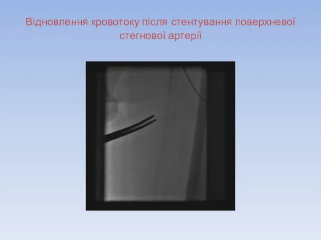Відновлення кровотоку після стентування поверхневої стегнової артерії