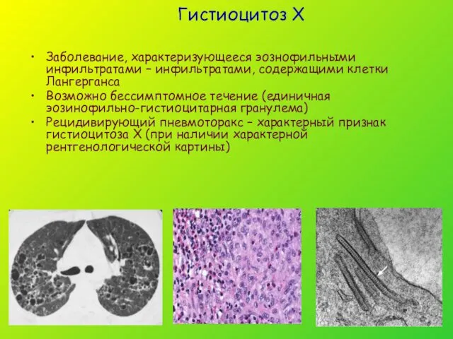 Гистиоцитоз Х Заболевание, характеризующееся эознофильными инфильтратами – инфильтратами, содержащими клетки Лангерганса