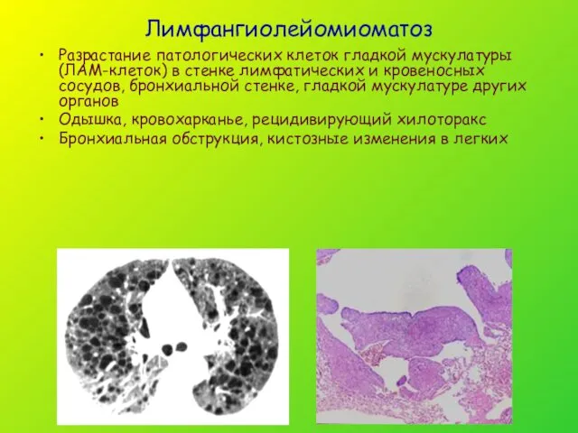 Лимфангиолейомиоматоз Разрастание патологических клеток гладкой мускулатуры (ЛАМ-клеток) в стенке лимфатических и