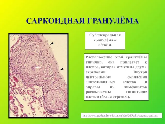 САРКОИДНАЯ ГРАНУЛЁМА Субплевральная гранулёма в лёгком. Расположение этой гранулёмы типично, она