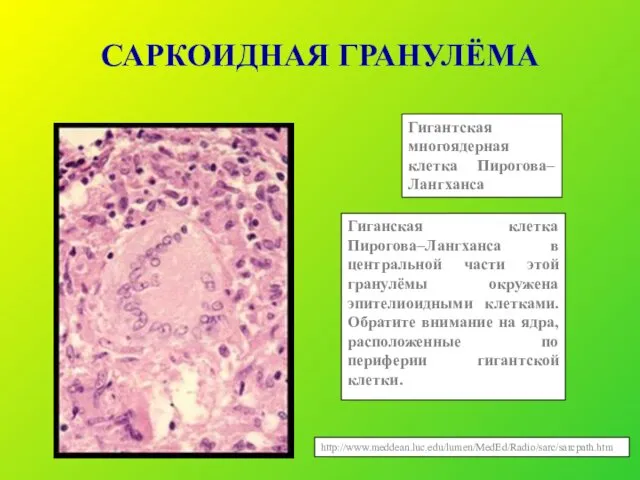 САРКОИДНАЯ ГРАНУЛЁМА Гигантская многоядерная клетка Пирогова–Лангханса Гиганская клетка Пирогова–Лангханса в центральной