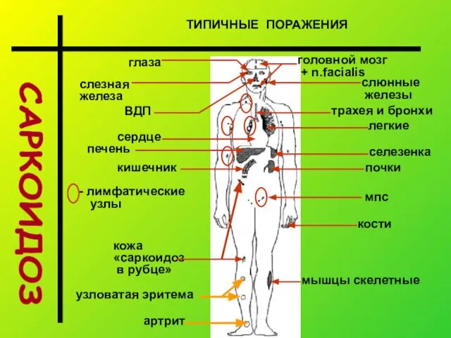 САРКОИДОЗ ТИПИЧНЫЕ ПОРАЖЕНИЯ лимфатические узлы легкие селезенка почки кости кожа «саркоидоз