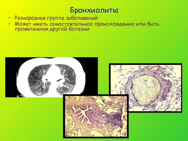 Бронхиолиты Разнородная группа заболеваний Может иметь самостоятельное происхождение или быть проявлением другой болезни