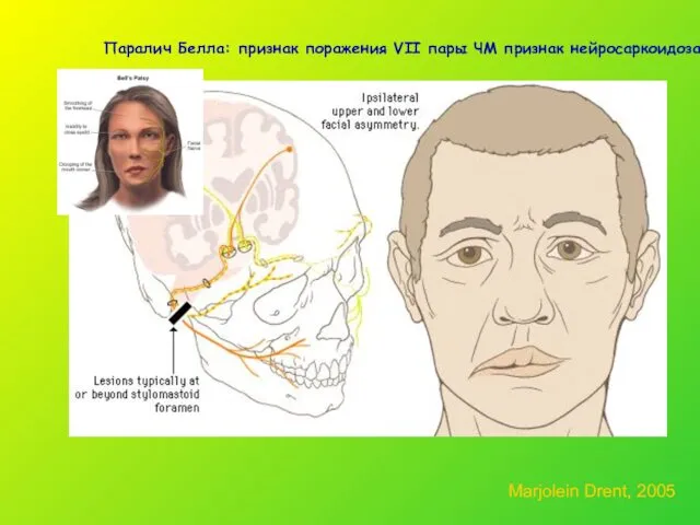 Паралич Белла: признак поражения VII пары ЧМ признак нейросаркоидоза Marjolein Drent, 2005