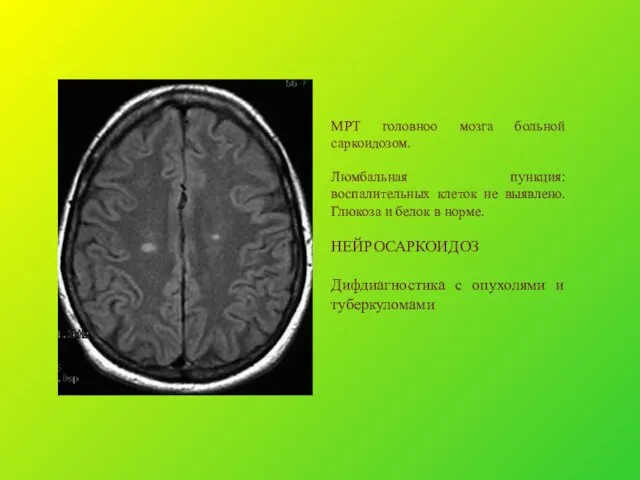 МРТ головноо мозга больной саркоидозом. Люмбальная пункция: воспалительных клеток не выявлено.