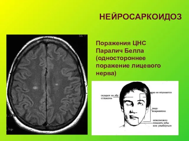 НЕЙРОСАРКОИДОЗ Поражения ЦНС Паралич Белла (одностороннее поражение лицевого нерва)