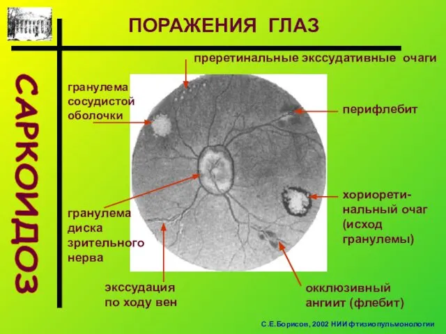 САРКОИДОЗ ПОРАЖЕНИЯ ГЛАЗ преретинальные экссудативные очаги гранулема сосудистой оболочки гранулема диска