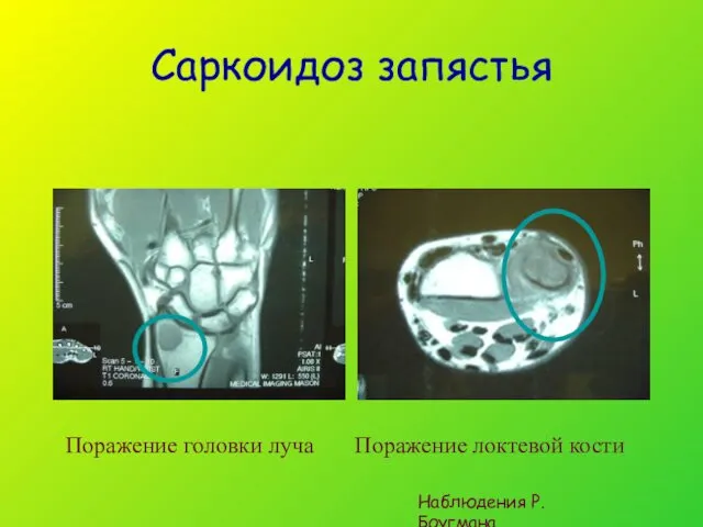 Саркоидоз запястья Поражение головки луча Поражение локтевой кости Наблюдения Р.Боугмана