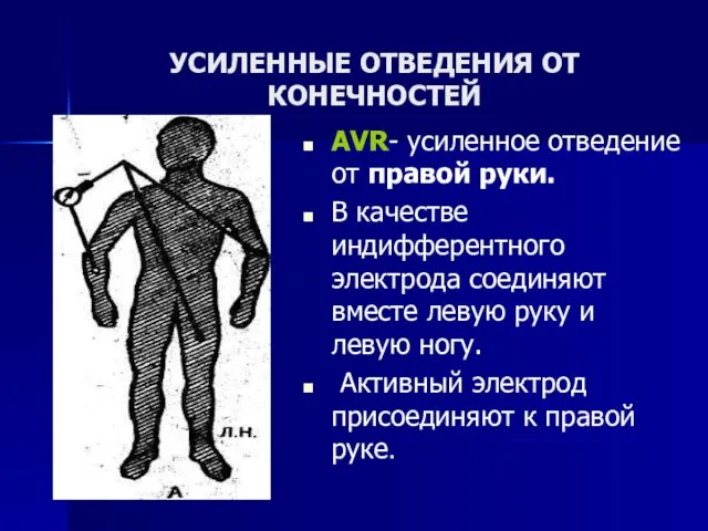 УСИЛЕННЫЕ ОТВЕДЕНИЯ ОТ КОНЕЧНОСТЕЙ АVR- усиленное отведение от правой руки. В