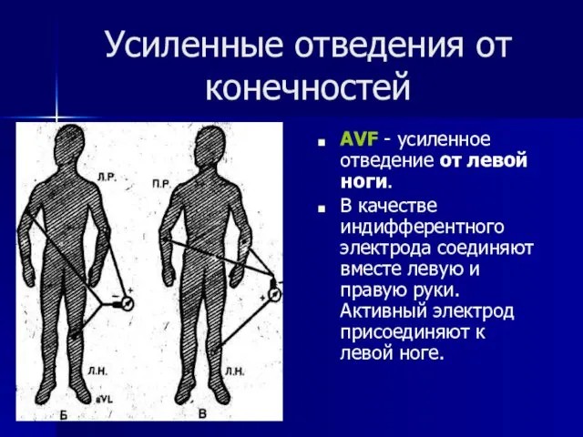 Усиленные отведения от конечностей АVF - усиленное отведение от левой ноги.