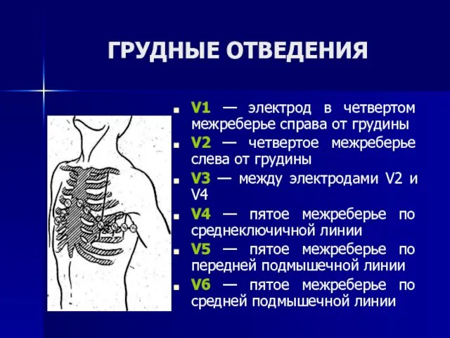 ГРУДНЫЕ ОТВЕДЕНИЯ V1 — электрод в четвертом межреберье справа от грудины