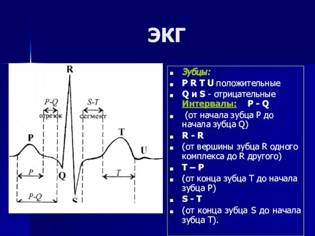 ЭКГ Зубцы: Р R T U положительные Q и S -