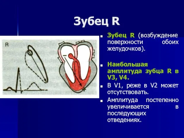 Зубец R Зубец R (возбуждение поверхности обоих желудочков). Наибольшая амплитуда зубца