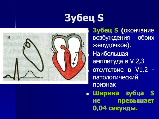 Зубец S Зубец S (окончание возбуждения обоих желудочков). Наибольшая амплитуда в