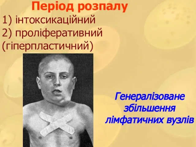 Період розпалу 1) інтоксикаційний 2) проліферативний (гіперпластичний) Генералізоване збільшення лімфатичних вузлів