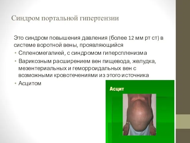 Синдром портальной гипертензии Это синдром повышения давления (более 12 мм рт