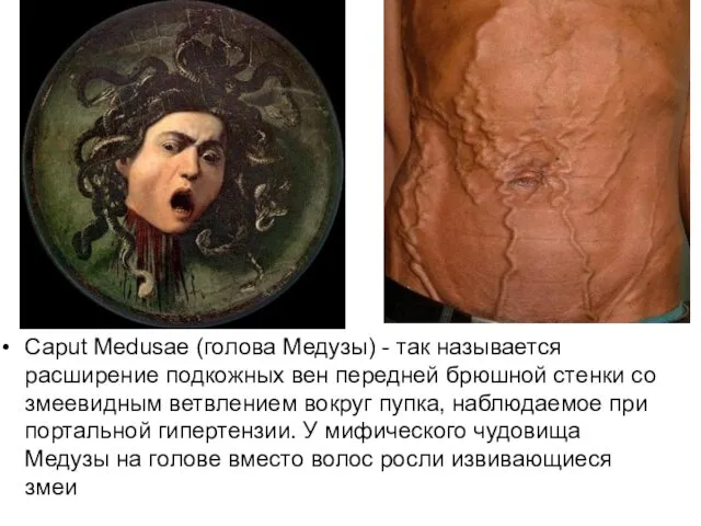 Caput Medusae (голова Медузы) - так называется расширение подкожных вен передней