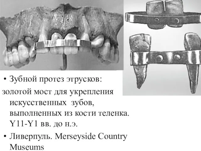 Зубной протез этрусков: золотой мост для укрепления искусственных зубов, выполненных из