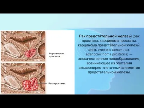 Рак предста́тельной железы́ (рак проста́ты, карцино́ма проста́ты, карцино́ма предста́тельной железы́; англ.