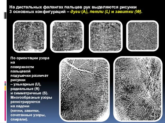 На дистальных фалангах пальцев рук выделяются рисунки 3 основных конфигураций –