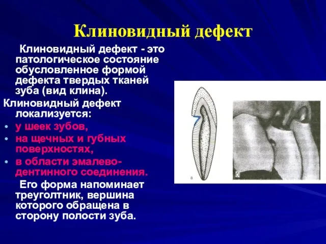 Клиновидный дефект Клиновидный дефект - это патологическое состояние обусловленное формой дефекта