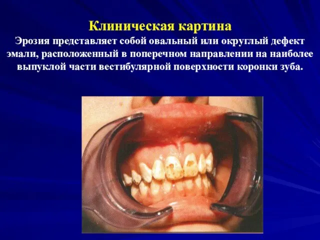 Клиническая картина Эрозия представляет собой овальный или округлый дефект эмали, расположенный