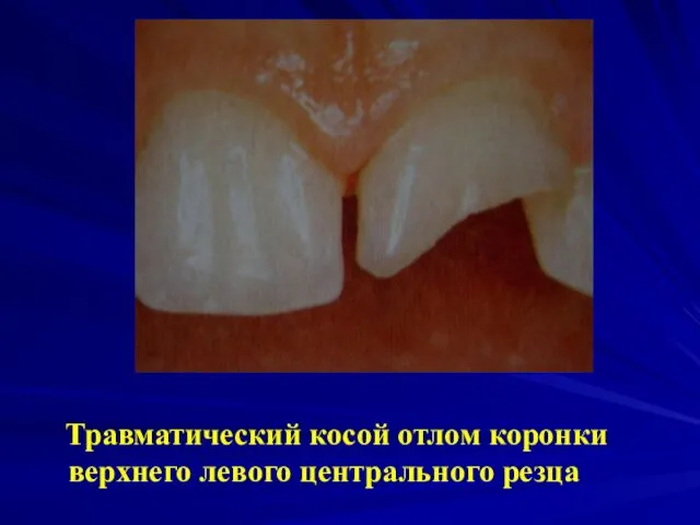 Травматический косой отлом коронки верхнего левого центрального резца