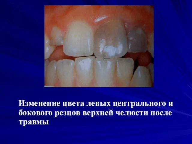 Изменение цвета левых центрального и бокового резцов верхней челюсти после травмы