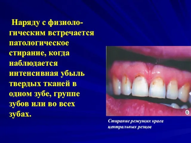 Наряду с физиоло-гическим встречается патологическое стирание, когда наблюдается интенсивная убыль твердых