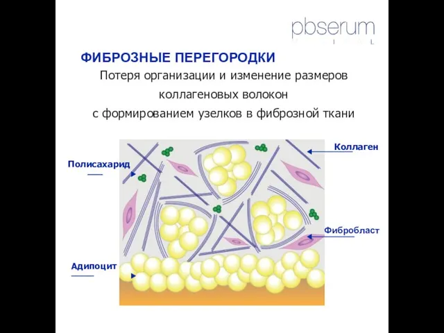 Коллаген Полисахарид ______ Фибробласт Адипоцит _________ ФИБРОЗНЫЕ ПЕРЕГОРОДКИ Потеря организации и