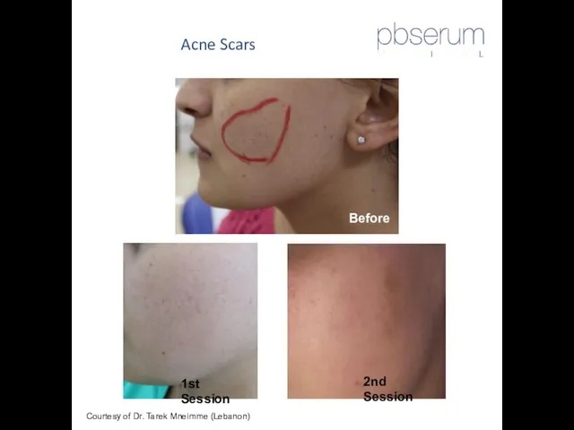 Acne Scars Courtesy of Dr. Tarek Mneimme (Lebanon) Before 1st Session 2nd Session