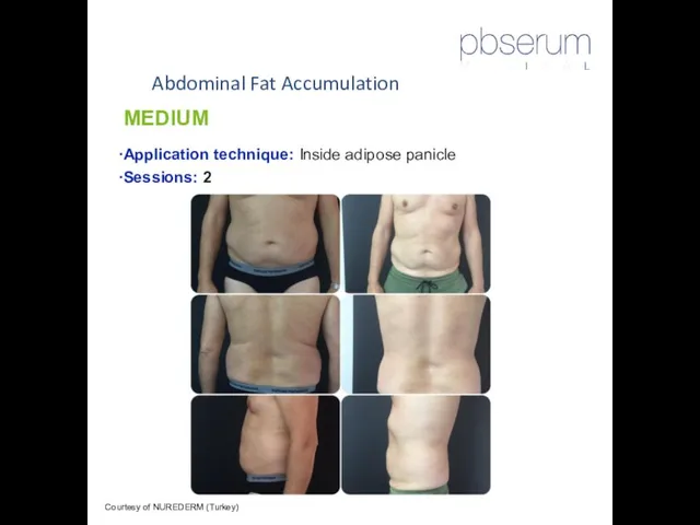 Abdominal Fat Accumulation Courtesy of NUREDERM (Turkey) MEDIUM Application technique: Inside adipose panicle Sessions: 2