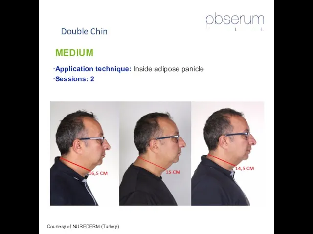 Double Chin Courtesy of NUREDERM (Turkey) MEDIUM Application technique: Inside adipose panicle Sessions: 2
