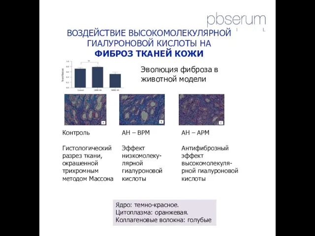 ВОЗДЕЙСТВИЕ ВЫСОКОМОЛЕКУЛЯРНОЙ ГИАЛУРОНОВОЙ КИСЛОТЫ НА ФИБРОЗ ТКАНЕЙ КОЖИ Контроль Гистологический разрез