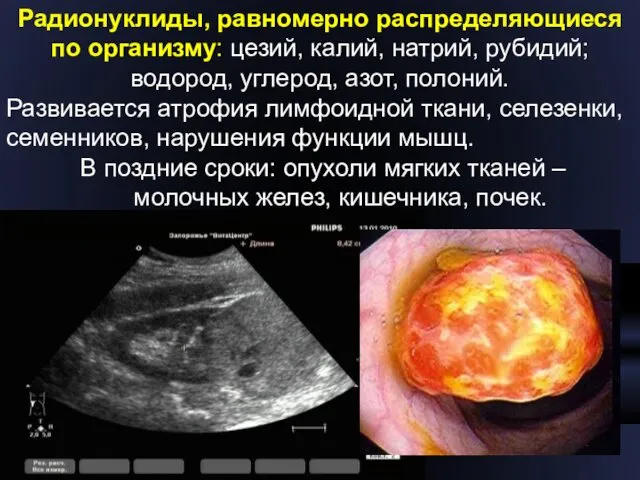 Радионуклиды, равномерно распределяющиеся по организму: цезий, калий, натрий, рубидий; водород, углерод,