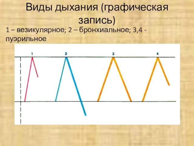 Виды дыхания (графическая запись) 1 – везикулярное; 2 – бронхиальное; 3,4 - пуэрильное