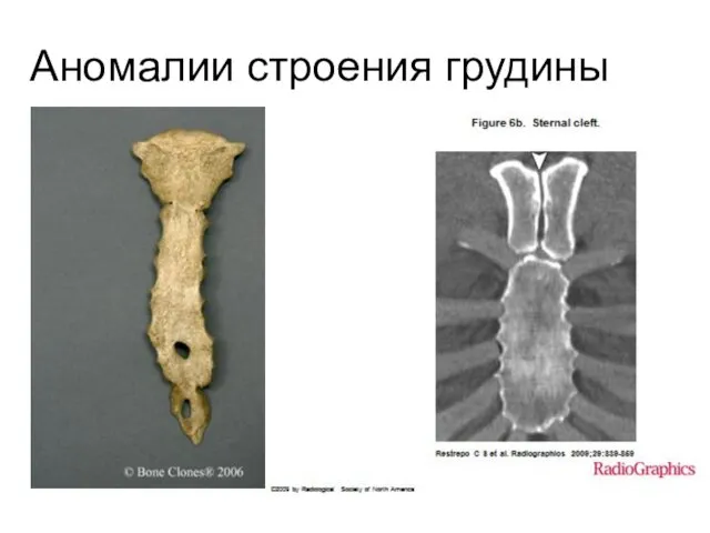 Аномалии строения грудины