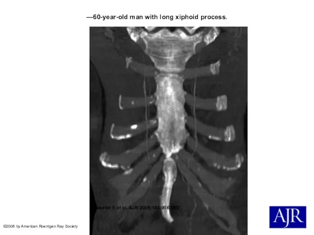 —60-year-old man with long xiphoid process. Yekeler E et al. AJR