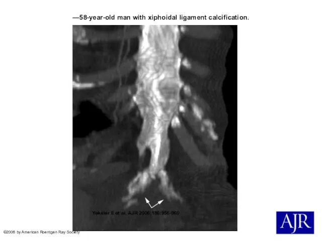 —58-year-old man with xiphoidal ligament calcification. Yekeler E et al. AJR
