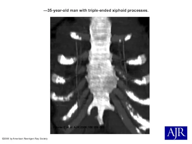 —35-year-old man with triple-ended xiphoid processes. Yekeler E et al. AJR