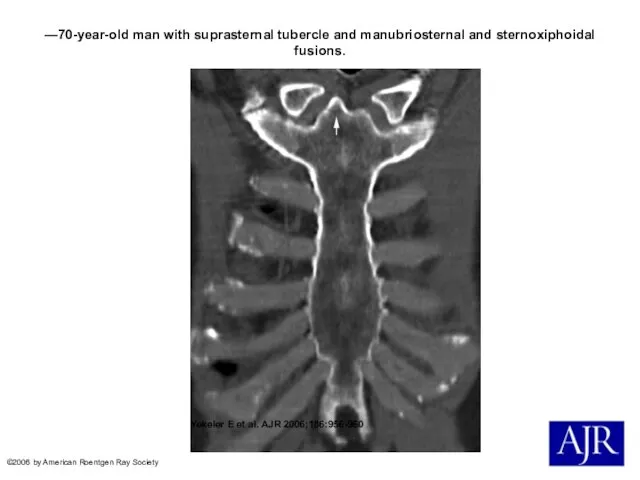—70-year-old man with suprasternal tubercle and manubriosternal and sternoxiphoidal fusions. Yekeler