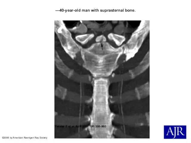 —40-year-old man with suprasternal bone. Yekeler E et al. AJR 2006;186:956-960