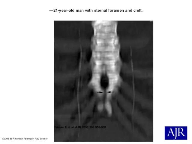 —21-year-old man with sternal foramen and cleft. Yekeler E et al.