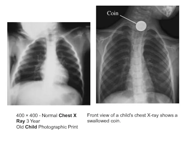 400 × 400 - Normal Chest X Ray 3 Year Old