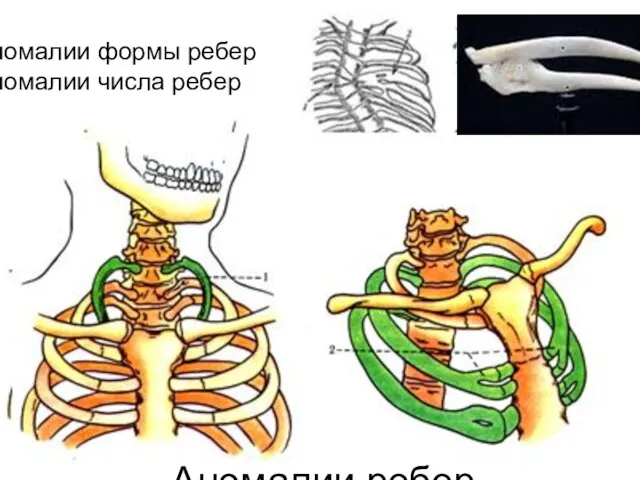 Аномалии ребер Аномалии формы ребер Аномалии числа ребер •