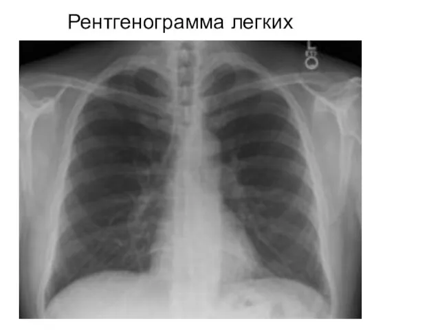 Рентгенограмма легких