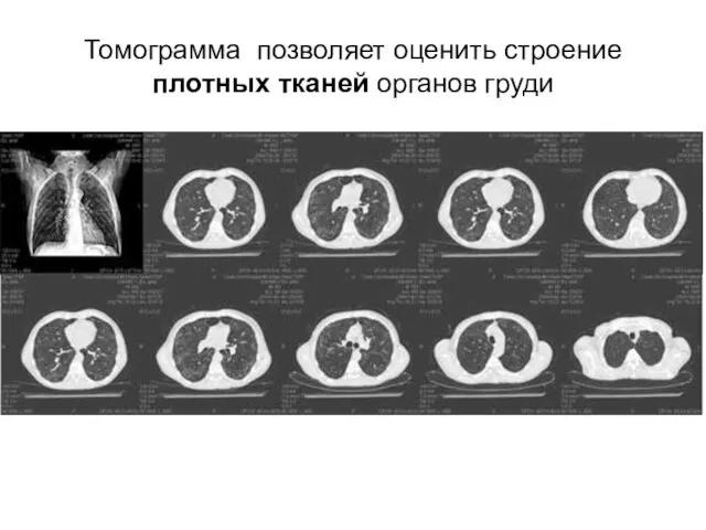Томограмма позволяет оценить строение плотных тканей органов груди