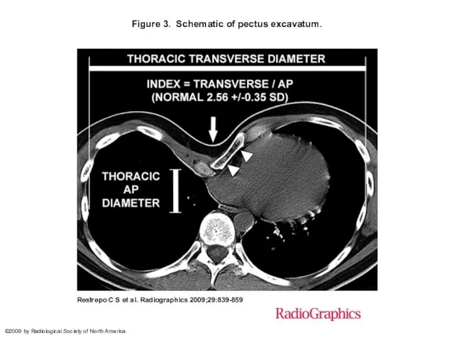 Figure 3. Schematic of pectus excavatum. Restrepo C S et al.