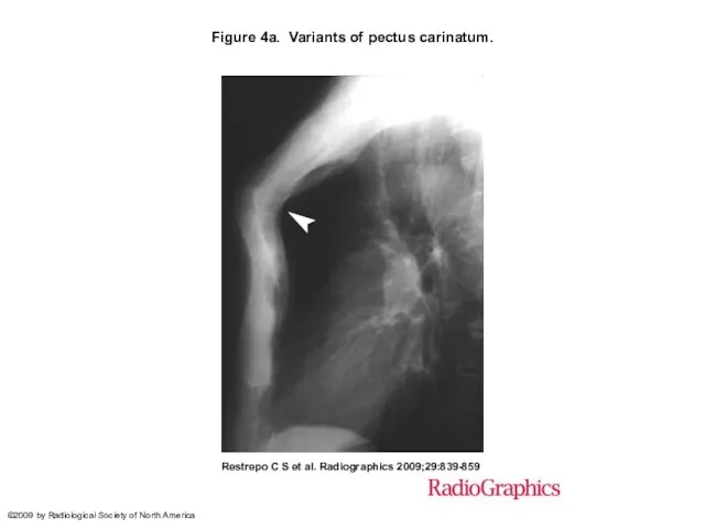 Figure 4a. Variants of pectus carinatum. Restrepo C S et al.